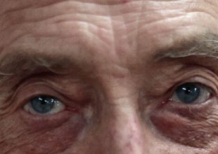 alzheimer-ojos
