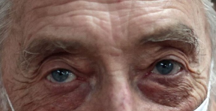 alzheimer-ojos