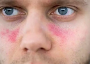 lupus